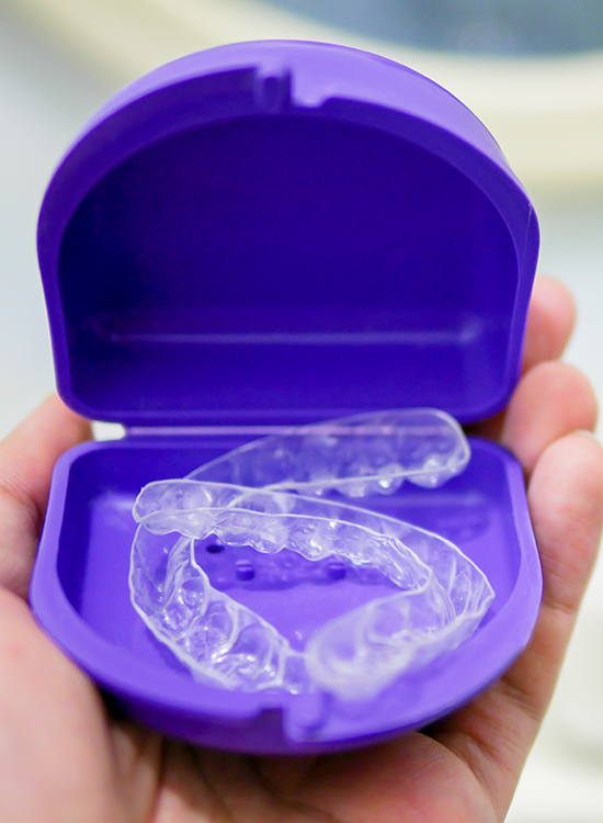 Why Are Retainers Important in Cape Coral